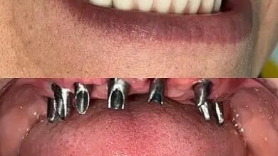 ایمپلنت دندان در ارومیه؛ راهنمای انتخاب بهترین روش برای جایگزینی دندان