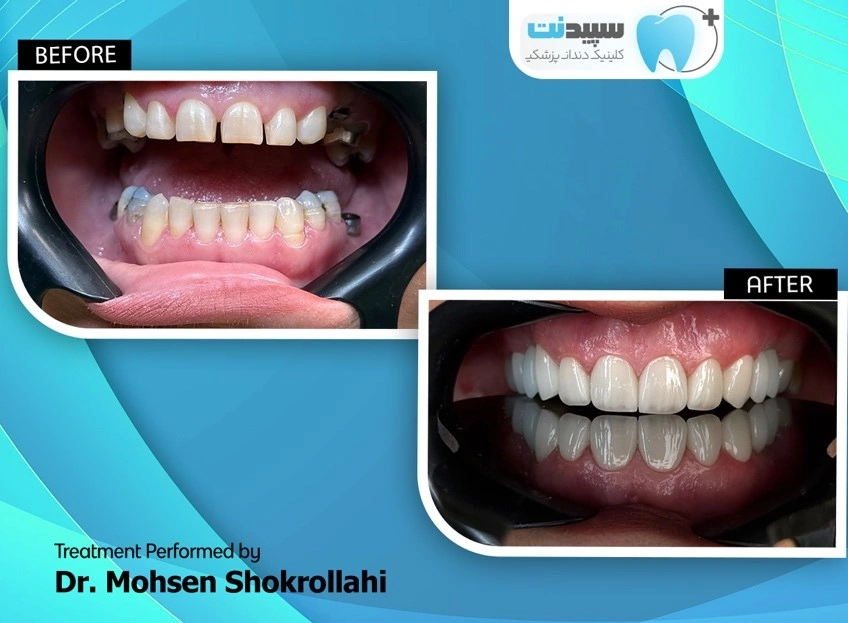نمونه کار لمینت دندان
