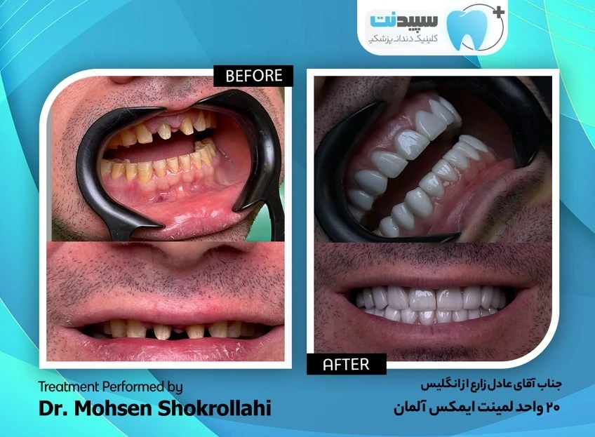 عکس لمینت دندان