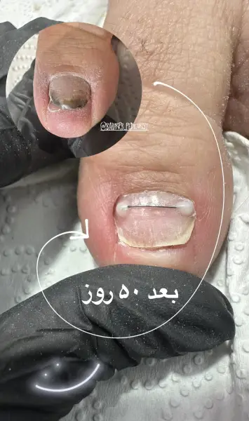 درمان ناخن فرو رفته در گوشت