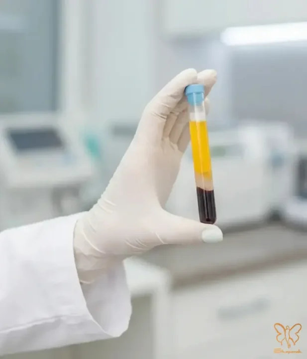 تزریق PRP